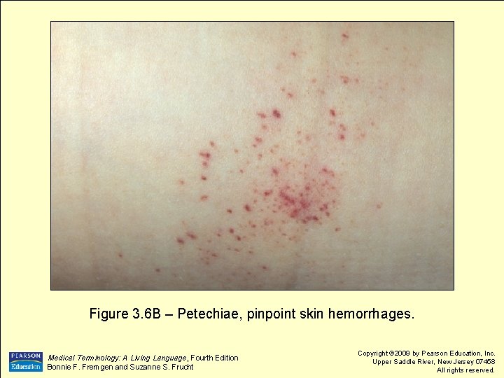 Figure 3. 6 B – Petechiae, pinpoint skin hemorrhages. Medical Terminology: A Living Language,