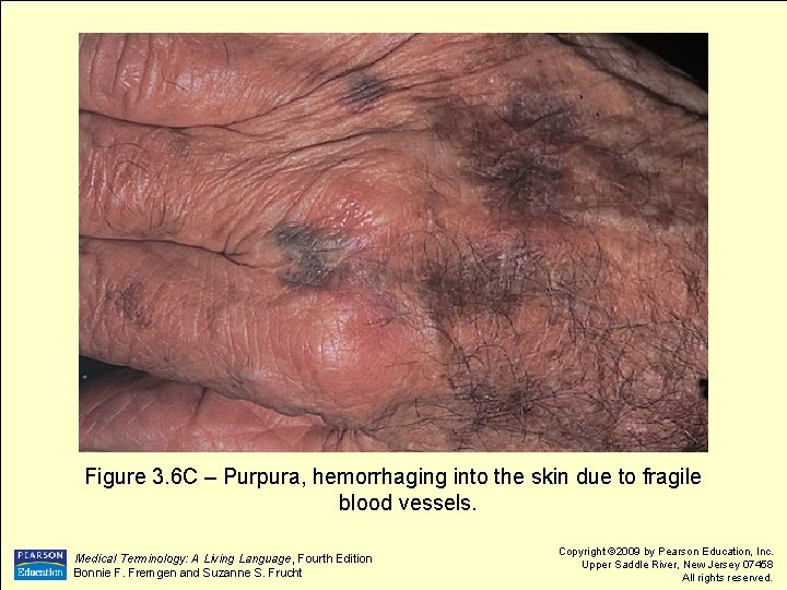 Figure 3. 6 C – Purpura, hemorrhaging into the skin due to fragile blood