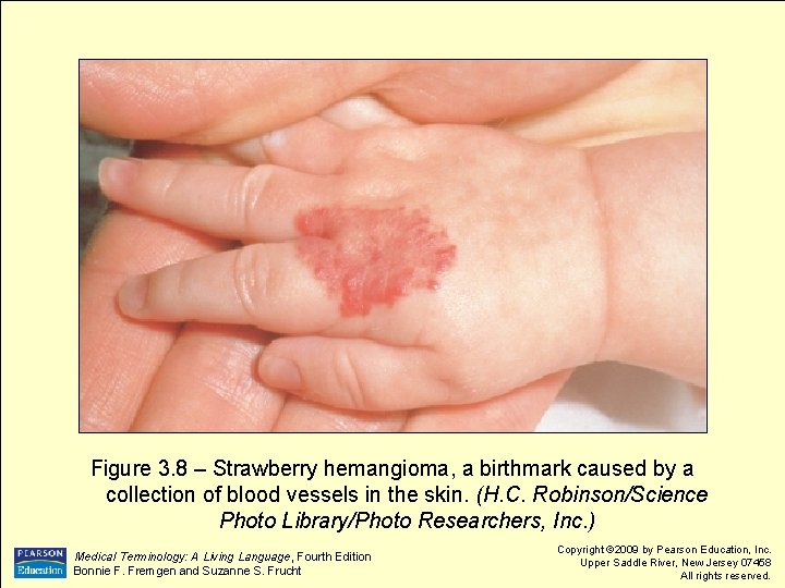 Figure 3. 8 – Strawberry hemangioma, a birthmark caused by a collection of blood