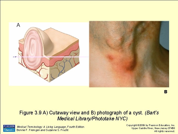 B Figure 3. 9 A) Cutaway view and B) photograph of a cyst. (Bart's