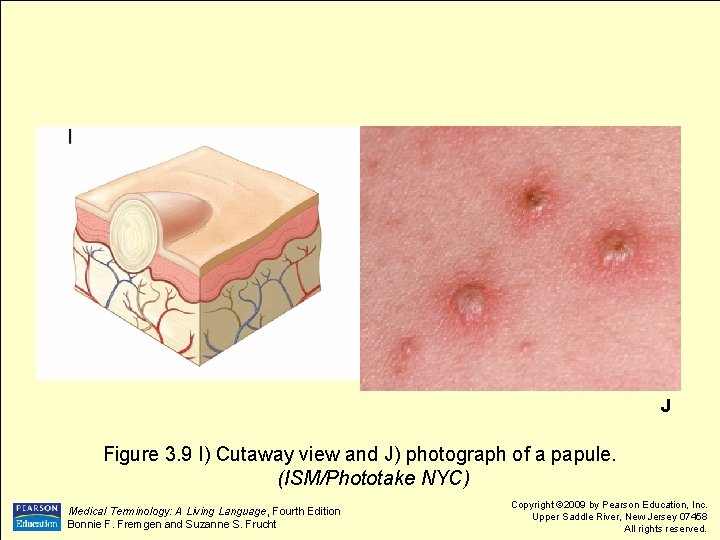 J Figure 3. 9 I) Cutaway view and J) photograph of a papule. (ISM/Phototake