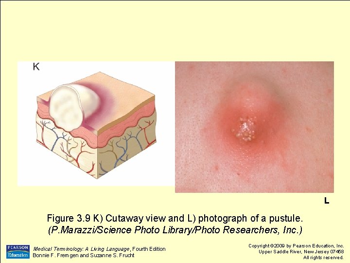 L Figure 3. 9 K) Cutaway view and L) photograph of a pustule. (P.