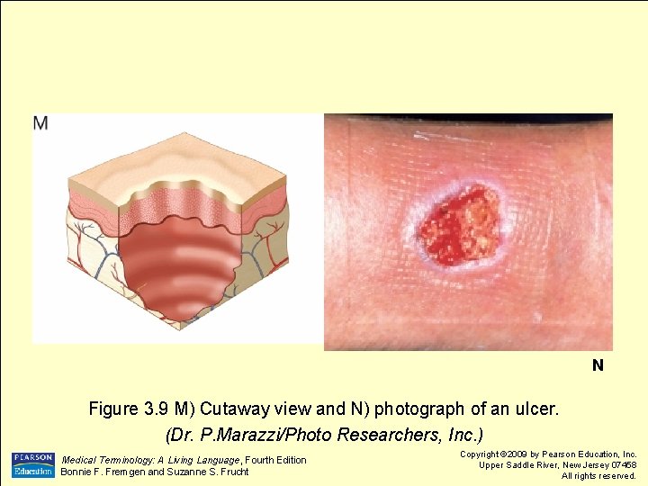 N Figure 3. 9 M) Cutaway view and N) photograph of an ulcer. (Dr.