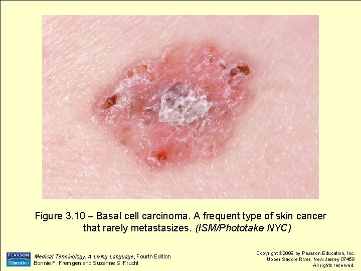 Figure 3. 10 – Basal cell carcinoma. A frequent type of skin cancer that