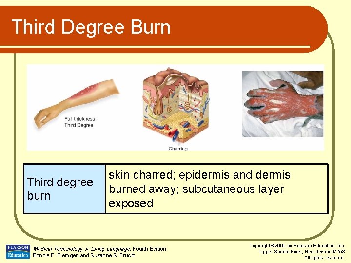 Third Degree Burn Third degree burn skin charred; epidermis and dermis burned away; subcutaneous