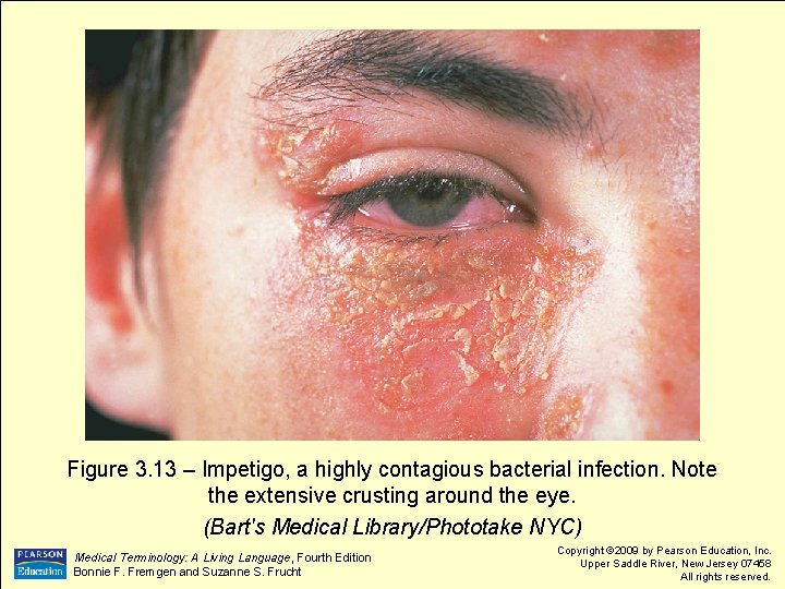 Figure 3. 13 – Impetigo, a highly contagious bacterial infection. Note the extensive crusting