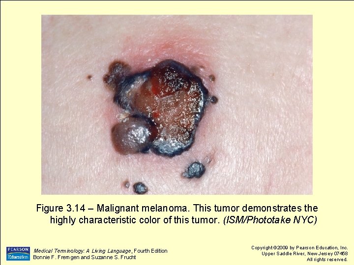 Figure 3. 14 – Malignant melanoma. This tumor demonstrates the highly characteristic color of