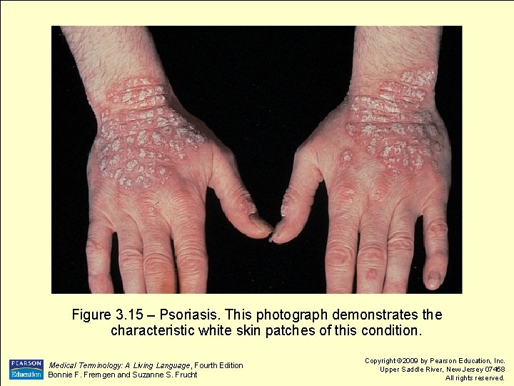 Figure 3. 15 – Psoriasis. This photograph demonstrates the characteristic white skin patches of