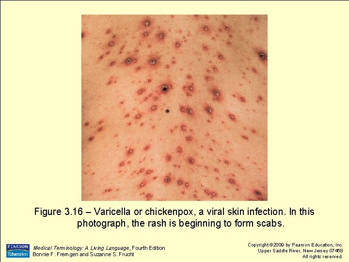Figure 3. 16 – Varicella or chickenpox, a viral skin infection. In this photograph,