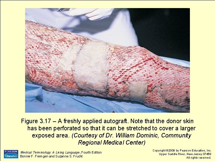 Figure 3. 17 – A freshly applied autograft. Note that the donor skin has