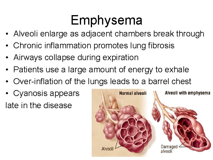 Emphysema • Alveoli enlarge as adjacent chambers break through • Chronic inflammation promotes lung