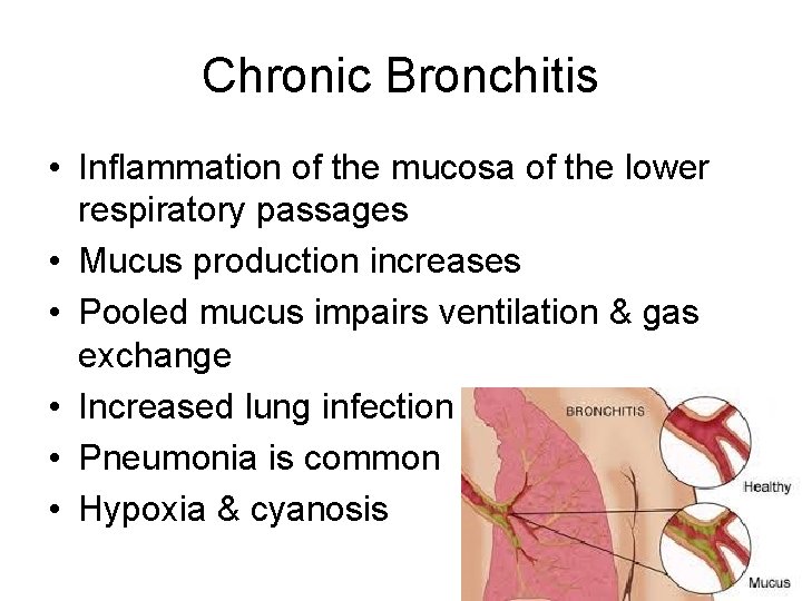 Chronic Bronchitis • Inflammation of the mucosa of the lower respiratory passages • Mucus