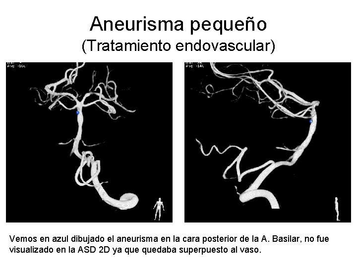 Aneurisma pequeño (Tratamiento endovascular) Vemos en azul dibujado el aneurisma en la cara posterior