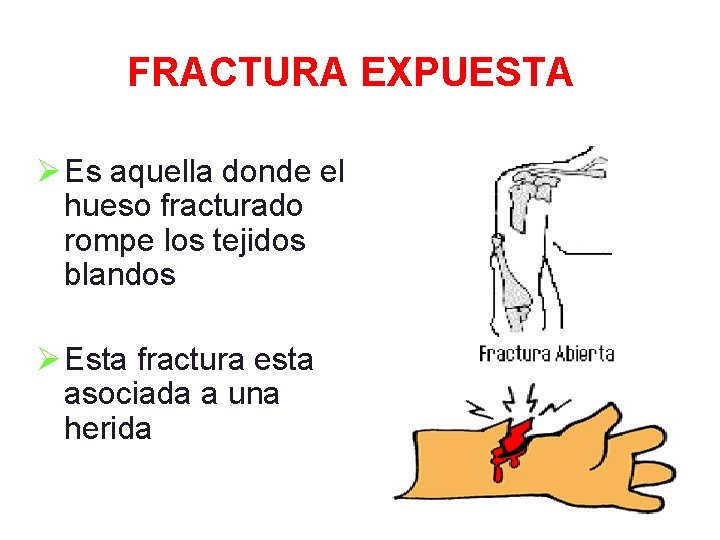 FRACTURA EXPUESTA Ø Es aquella donde el hueso fracturado rompe los tejidos blandos Ø