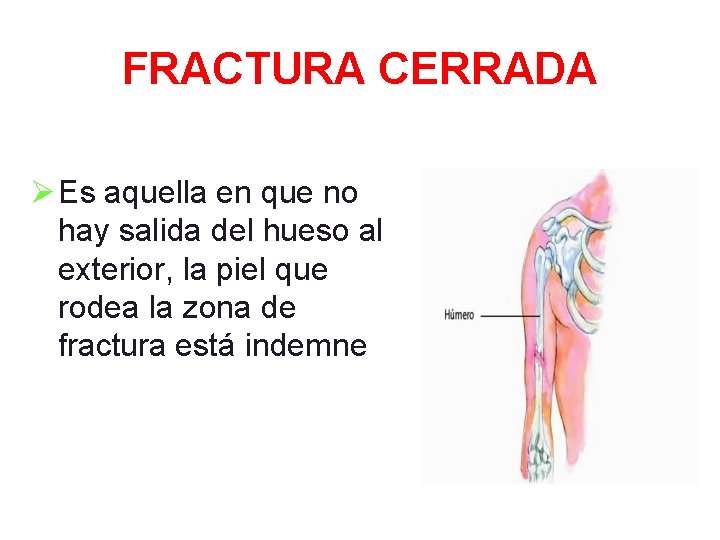 FRACTURA CERRADA Ø Es aquella en que no hay salida del hueso al exterior,