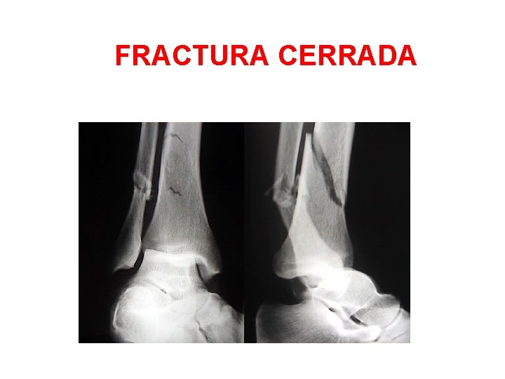 FRACTURA CERRADA 
