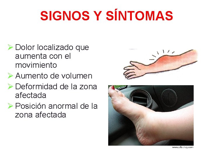 SIGNOS Y SÍNTOMAS Ø Dolor localizado que aumenta con el movimiento Ø Aumento de