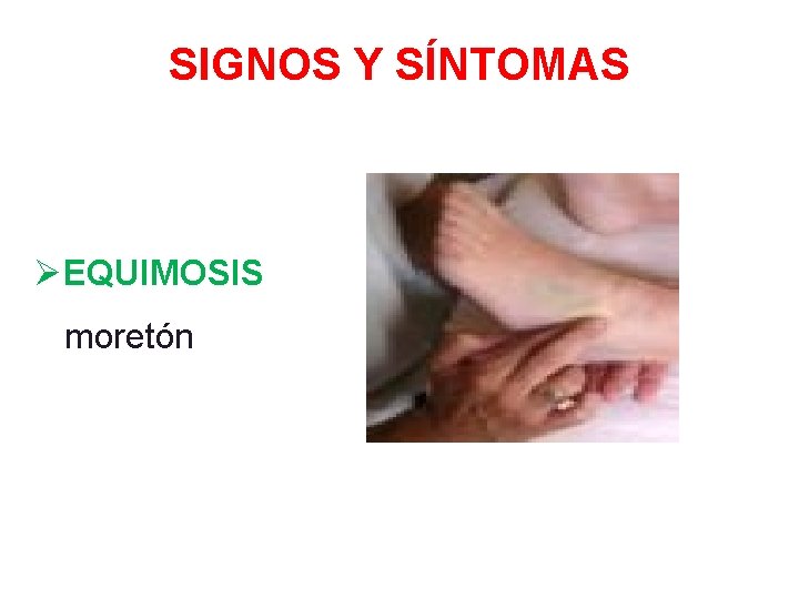 SIGNOS Y SÍNTOMAS ØEQUIMOSIS moretón 