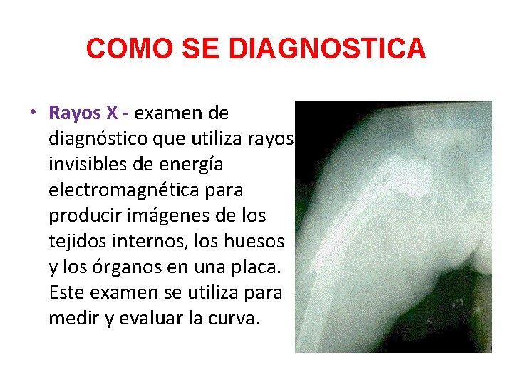 COMO SE DIAGNOSTICA • Rayos X - examen de diagnóstico que utiliza rayos invisibles