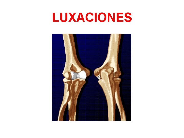 LUXACIONES 