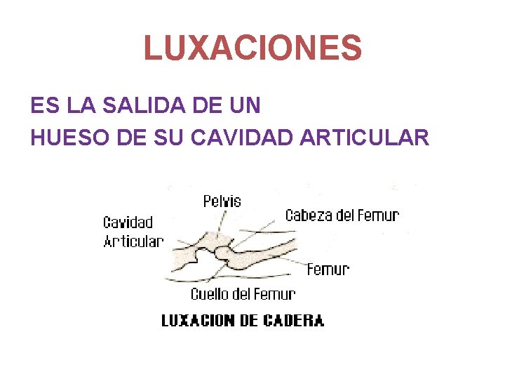 LUXACIONES ES LA SALIDA DE UN HUESO DE SU CAVIDAD ARTICULAR 