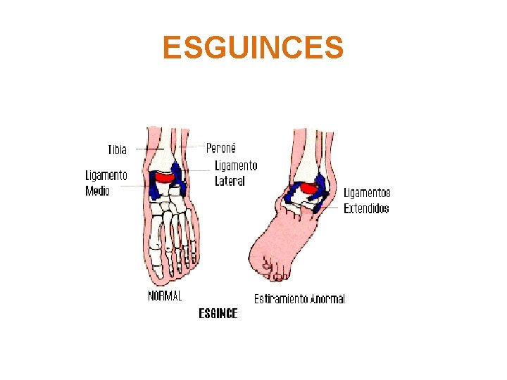 ESGUINCES 