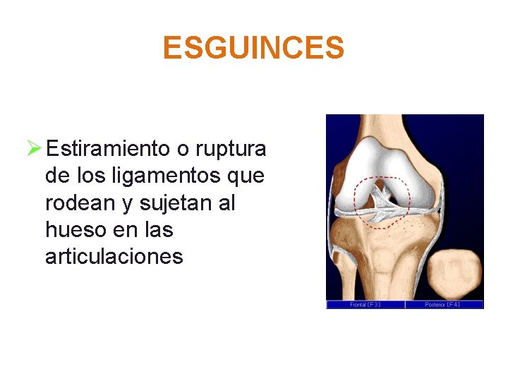 ESGUINCES Ø Estiramiento o ruptura de los ligamentos que rodean y sujetan al hueso