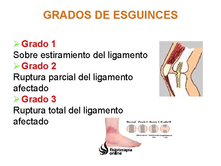 GRADOS DE ESGUINCES Ø Grado 1 Sobre estiramiento del ligamento Ø Grado 2 Ruptura
