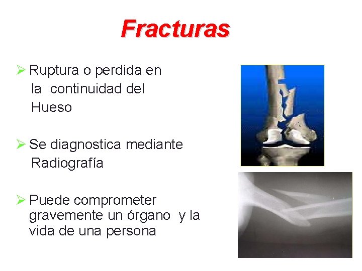 Fracturas Ø Ruptura o perdida en la continuidad del Hueso Ø Se diagnostica mediante