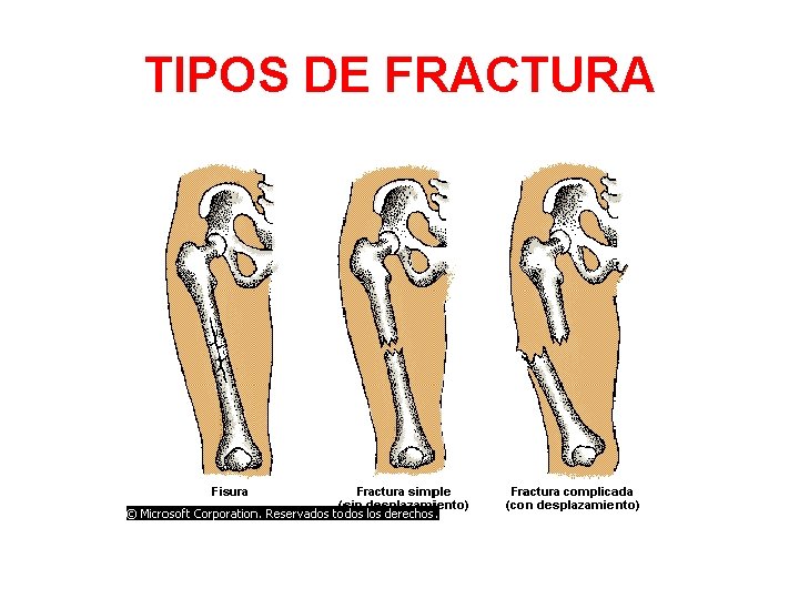 TIPOS DE FRACTURA 
