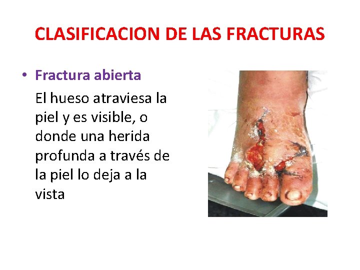 CLASIFICACION DE LAS FRACTURAS • Fractura abierta El hueso atraviesa la piel y es