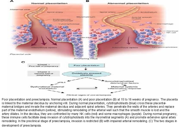 Poor placentation and preeclampsia. Normal placentation (A) and poor placentation (B) at 15 to