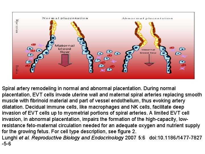 Spiral artery remodeling in normal and abnormal placentation. During normal placentation, EVT cells invade