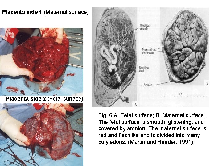 Placenta side 1 (Maternal surface) Placenta side 2 (Fetal surface) Fig. 6 A, Fetal