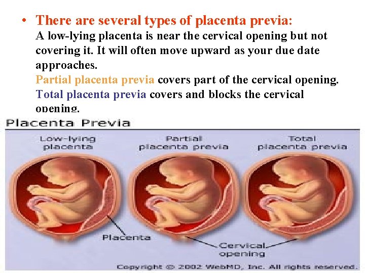  • There are several types of placenta previa: A low-lying placenta is near