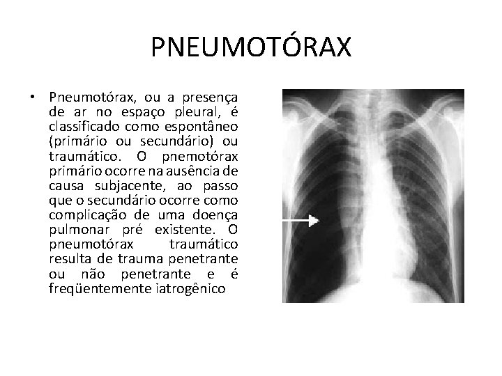 PNEUMOTÓRAX • Pneumotórax, ou a presença de ar no espaço pleural, é classificado como PNEUMOTÓRAX • Pneumotórax, ou a presença de ar no espaço pleural, é classificado como