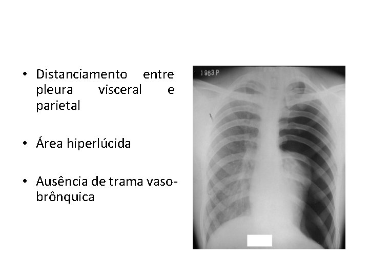 • Distanciamento entre pleura visceral e parietal • Área hiperlúcida • Ausência de • Distanciamento entre pleura visceral e parietal • Área hiperlúcida • Ausência de