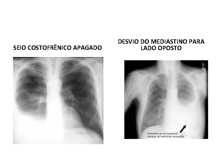 SEIO COSTOFRÊNICO APAGADO DESVIO DO MEDIASTINO PARA LADO OPOSTO SEIO COSTOFRÊNICO APAGADO DESVIO DO MEDIASTINO PARA LADO OPOSTO