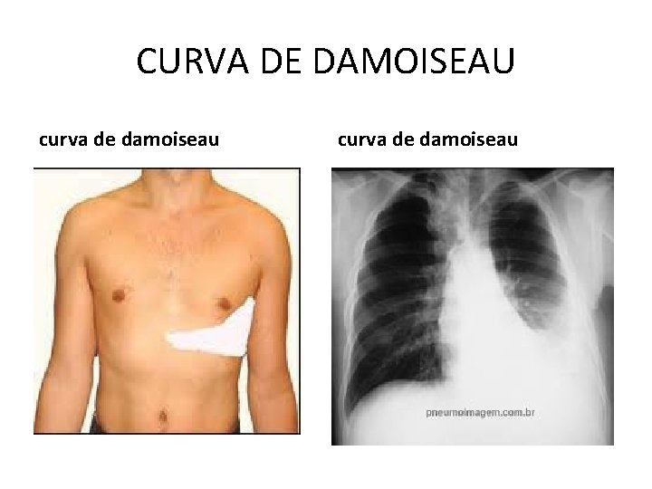 RX DE TRAX PNEUMOPATIAS ATELECTASIAS A atelectasia uma — free download
