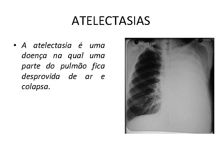 ATELECTASIAS • A atelectasia é uma doença na qual uma parte do pulmão fica ATELECTASIAS • A atelectasia é uma doença na qual uma parte do pulmão fica