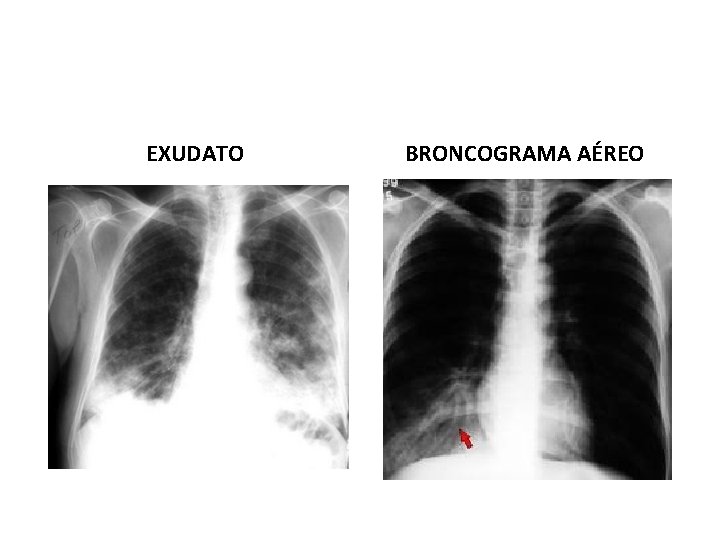 EXUDATO BRONCOGRAMA AÉREO EXUDATO BRONCOGRAMA AÉREO
