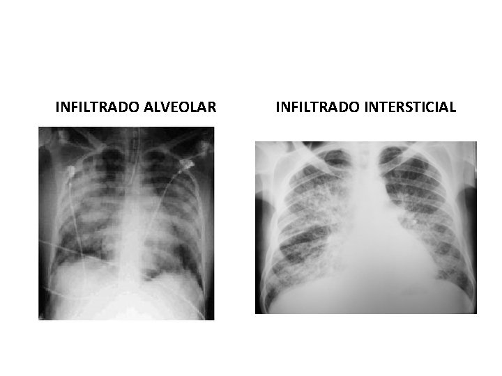 INFILTRADO ALVEOLAR INFILTRADO INTERSTICIAL INFILTRADO ALVEOLAR INFILTRADO INTERSTICIAL