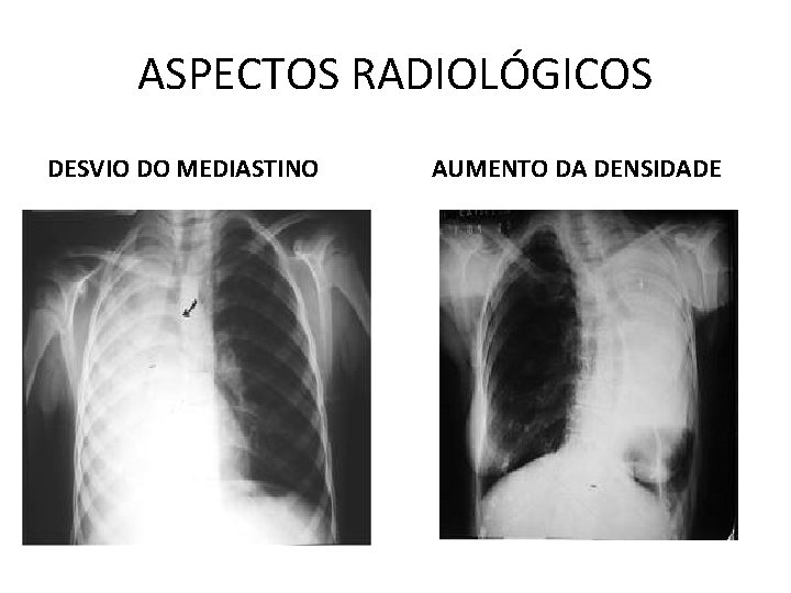 ASPECTOS RADIOLÓGICOS DESVIO DO MEDIASTINO AUMENTO DA DENSIDADE ASPECTOS RADIOLÓGICOS DESVIO DO MEDIASTINO AUMENTO DA DENSIDADE