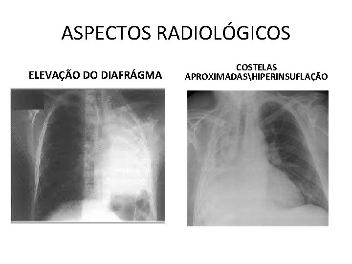ASPECTOS RADIOLÓGICOS ELEVAÇÃO DO DIAFRÁGMA COSTELAS APROXIMADASHIPERINSUFLAÇÃO ASPECTOS RADIOLÓGICOS ELEVAÇÃO DO DIAFRÁGMA COSTELAS APROXIMADASHIPERINSUFLAÇÃO