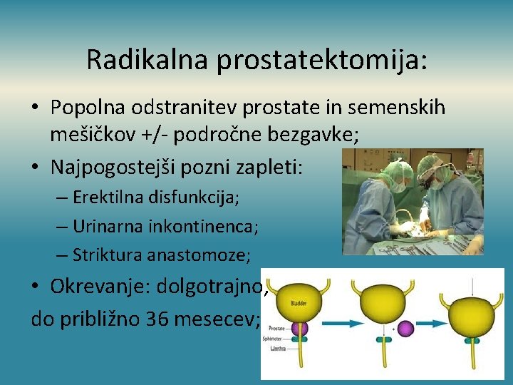 Radikalna prostatektomija: • Popolna odstranitev prostate in semenskih mešičkov +/- področne bezgavke; • Najpogostejši