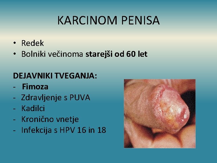 KARCINOM PENISA • Redek • Bolniki večinoma starejši od 60 let DEJAVNIKI TVEGANJA: -