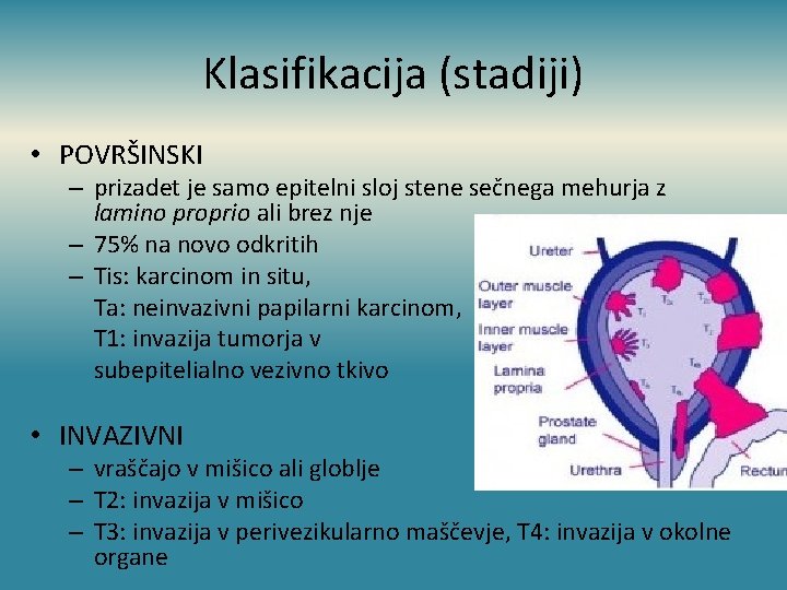 Klasifikacija (stadiji) • POVRŠINSKI – prizadet je samo epitelni sloj stene sečnega mehurja z