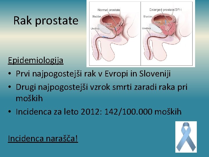 Rak prostate Epidemiologija • Prvi najpogostejši rak v Evropi in Sloveniji • Drugi najpogostejši