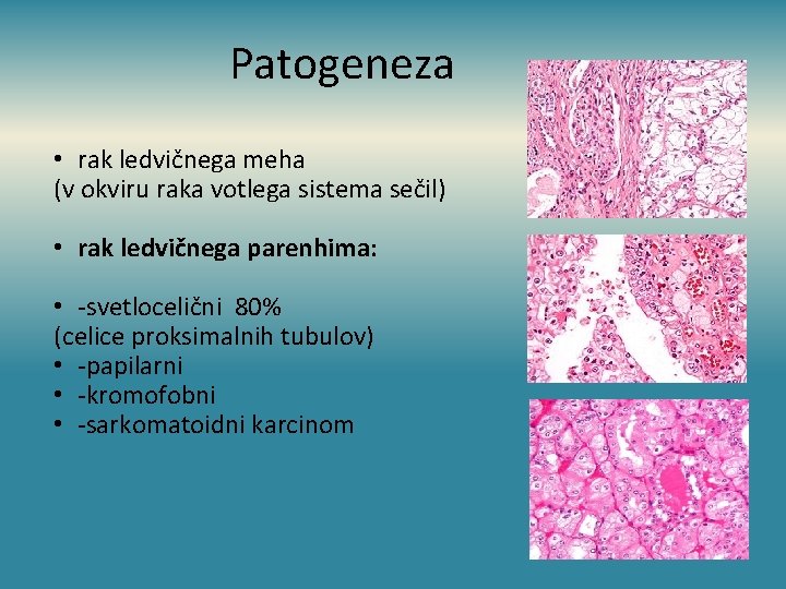 Patogeneza • rak ledvičnega meha (v okviru raka votlega sistema sečil) • rak ledvičnega
