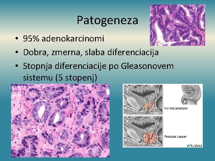 Patogeneza • 95% adenokarcinomi • Dobra, zmerna, slaba diferenciacija • Stopnja diferenciacije po Gleasonovem